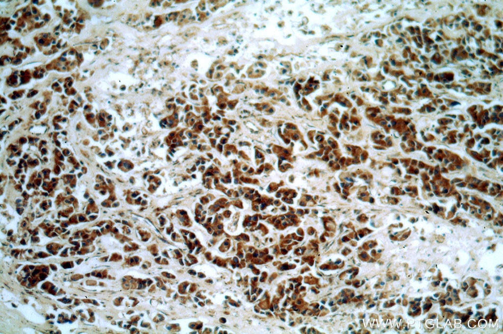 Immunohistochemistry (IHC) staining of human breast cancer tissue using STARD3NL Polyclonal antibody (20502-1-AP)