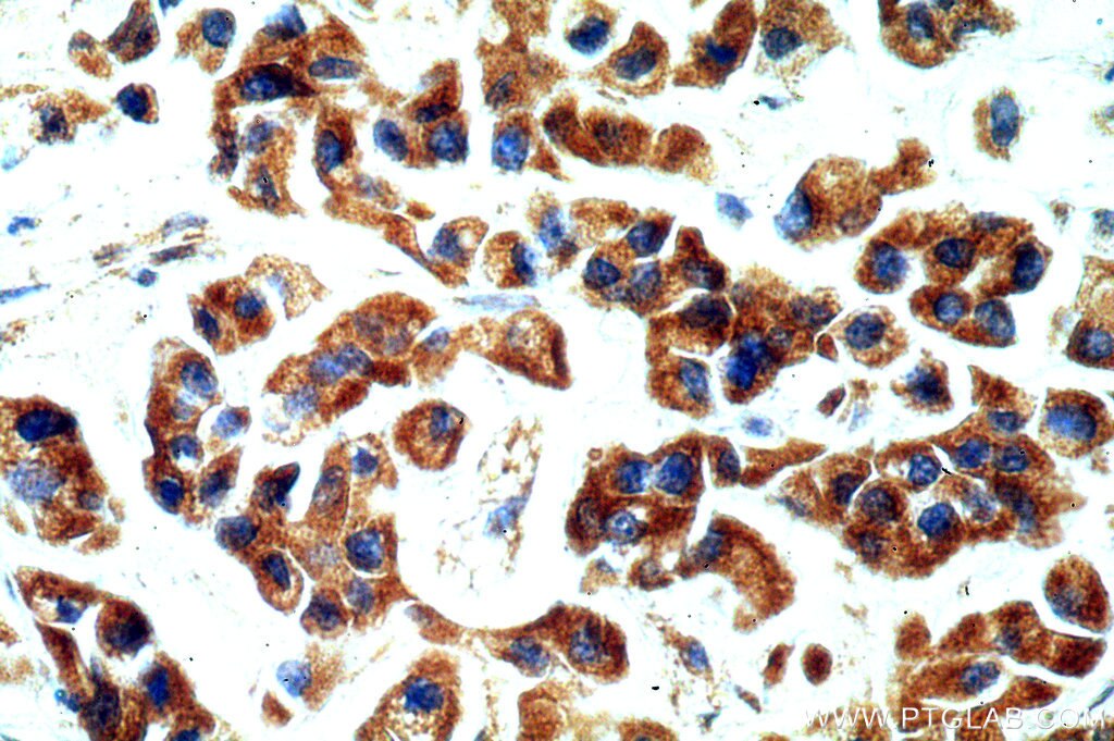 Immunohistochemistry (IHC) staining of human breast cancer tissue using STARD3NL Polyclonal antibody (20502-1-AP)