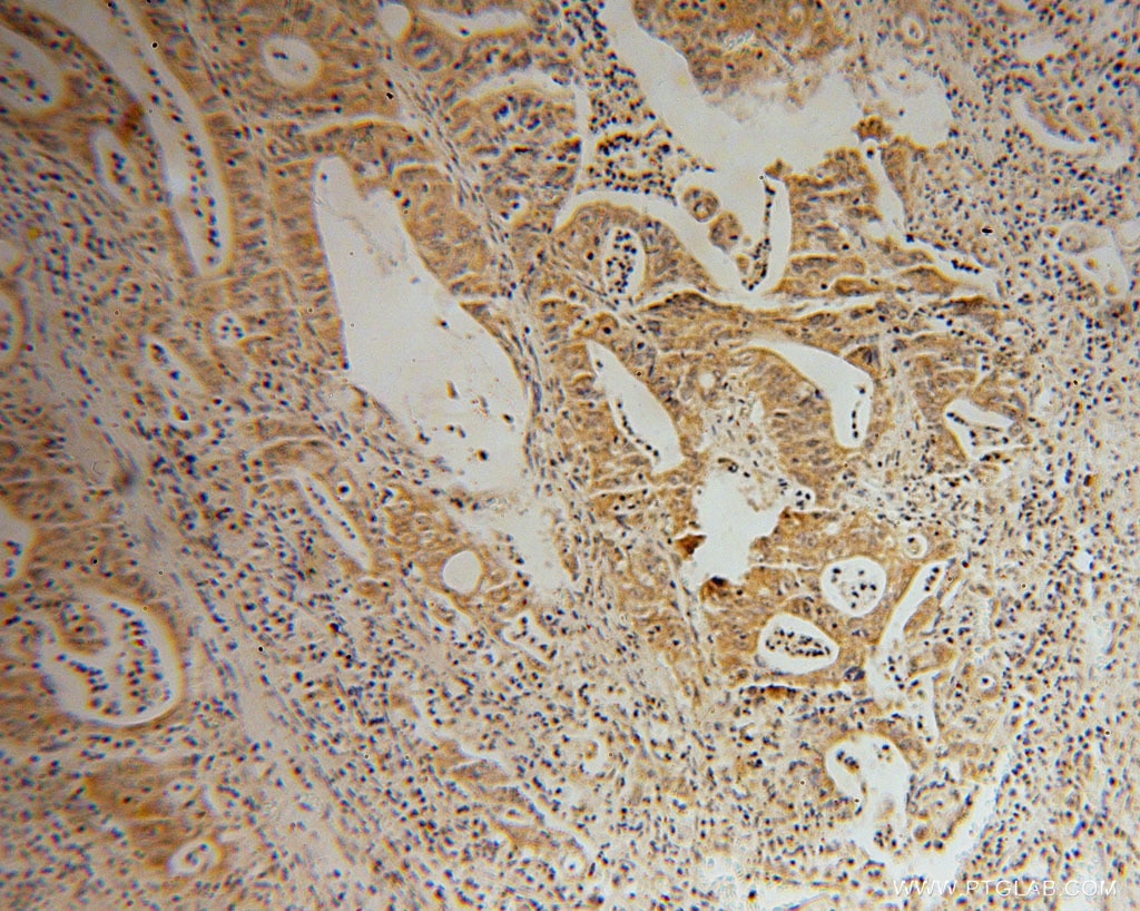 Immunohistochemistry (IHC) staining of human colon cancer tissue using STARD7 Polyclonal antibody (15689-1-AP)