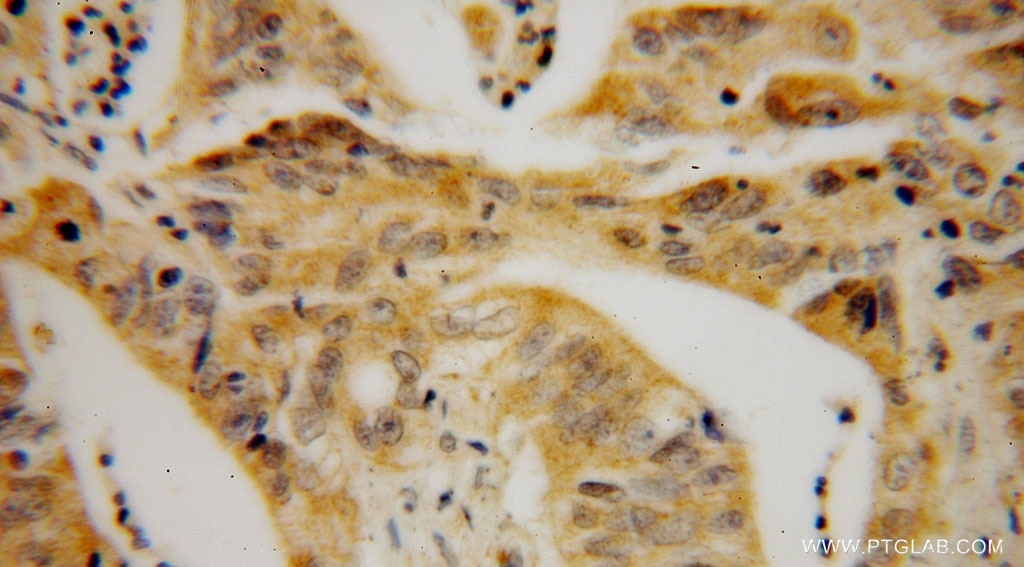 Immunohistochemistry (IHC) staining of human colon cancer tissue using STARD7 Polyclonal antibody (15689-1-AP)