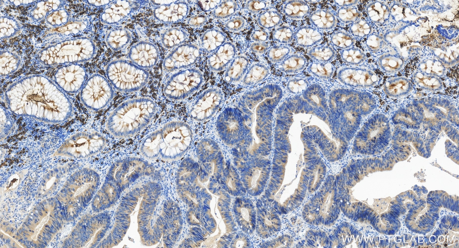Immunohistochemistry (IHC) staining of human colon cancer tissue using STARD7 Recombinant antibody (85131-4-RR)