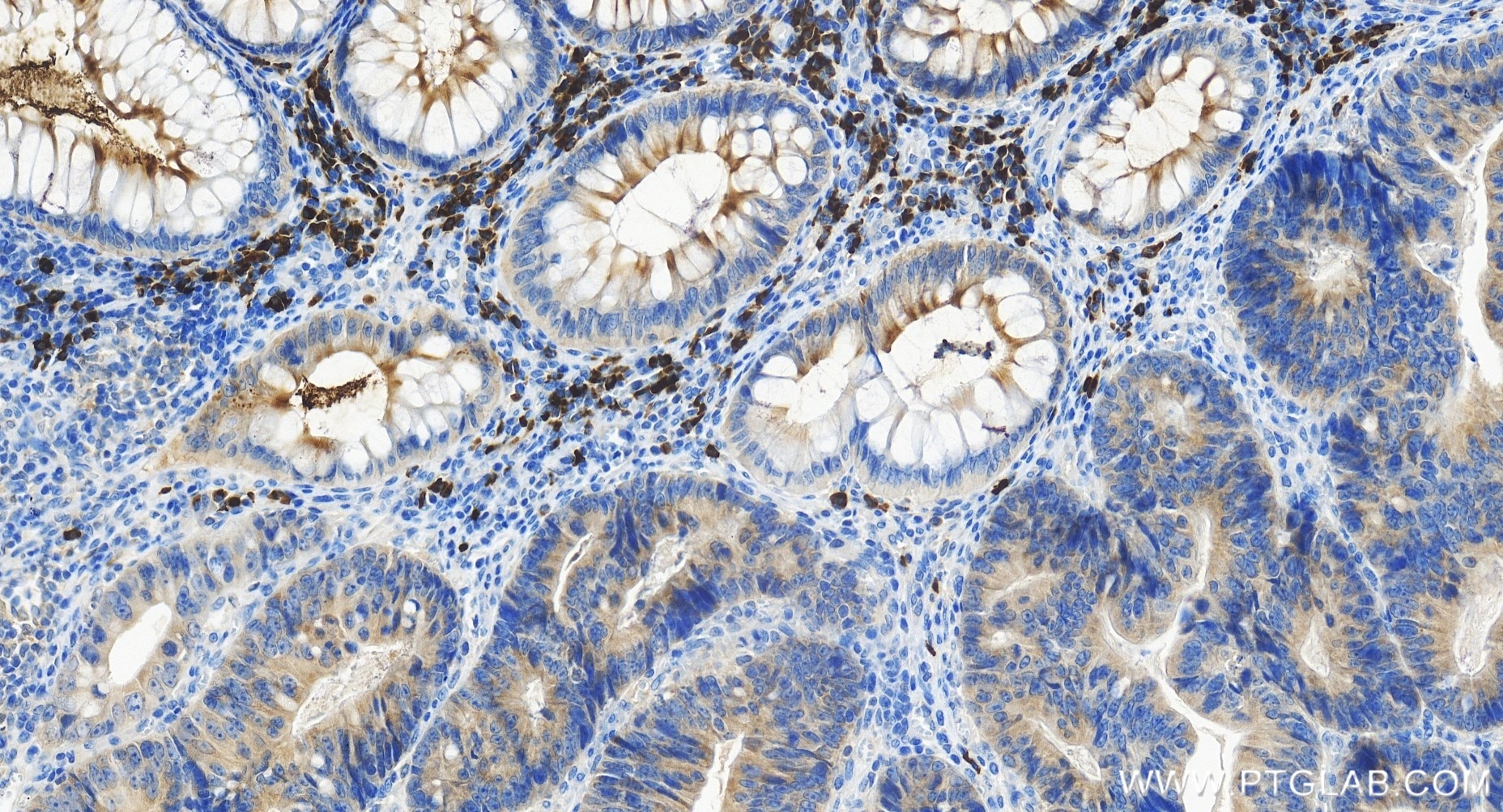 Immunohistochemistry (IHC) staining of human colon cancer tissue using STARD7 Recombinant antibody (85131-4-RR)
