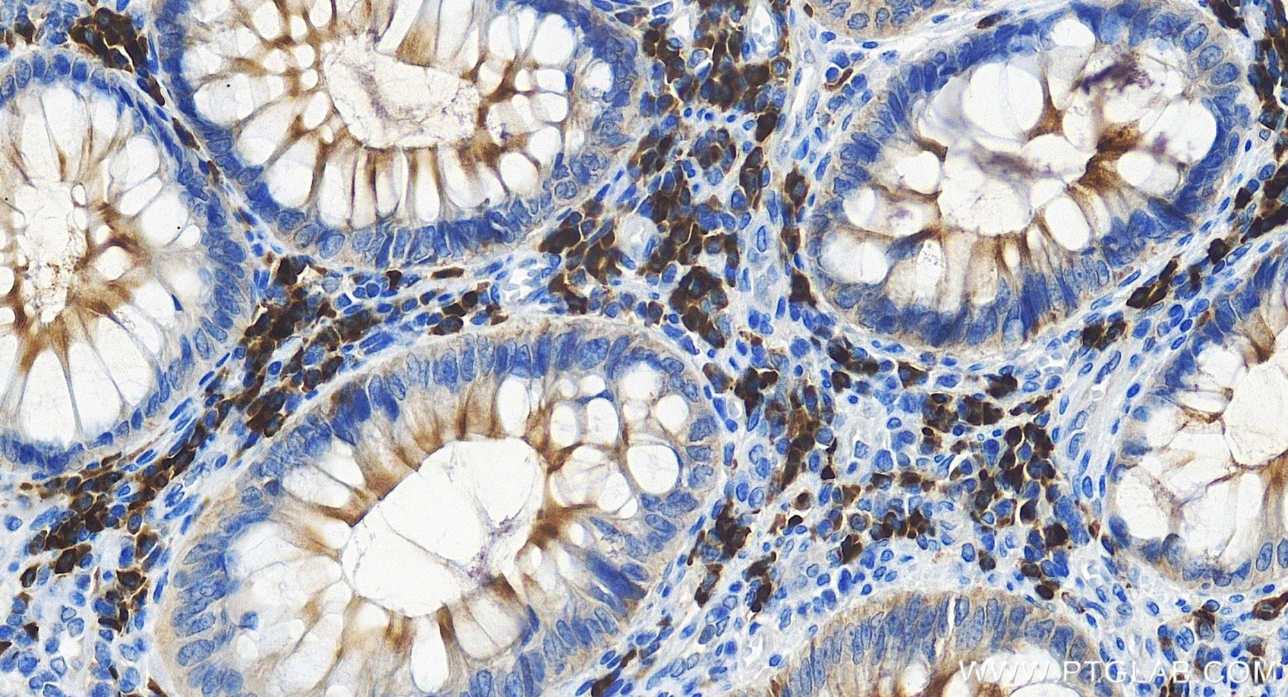 Immunohistochemistry (IHC) staining of human colon cancer tissue using STARD7 Recombinant antibody (85131-4-RR)