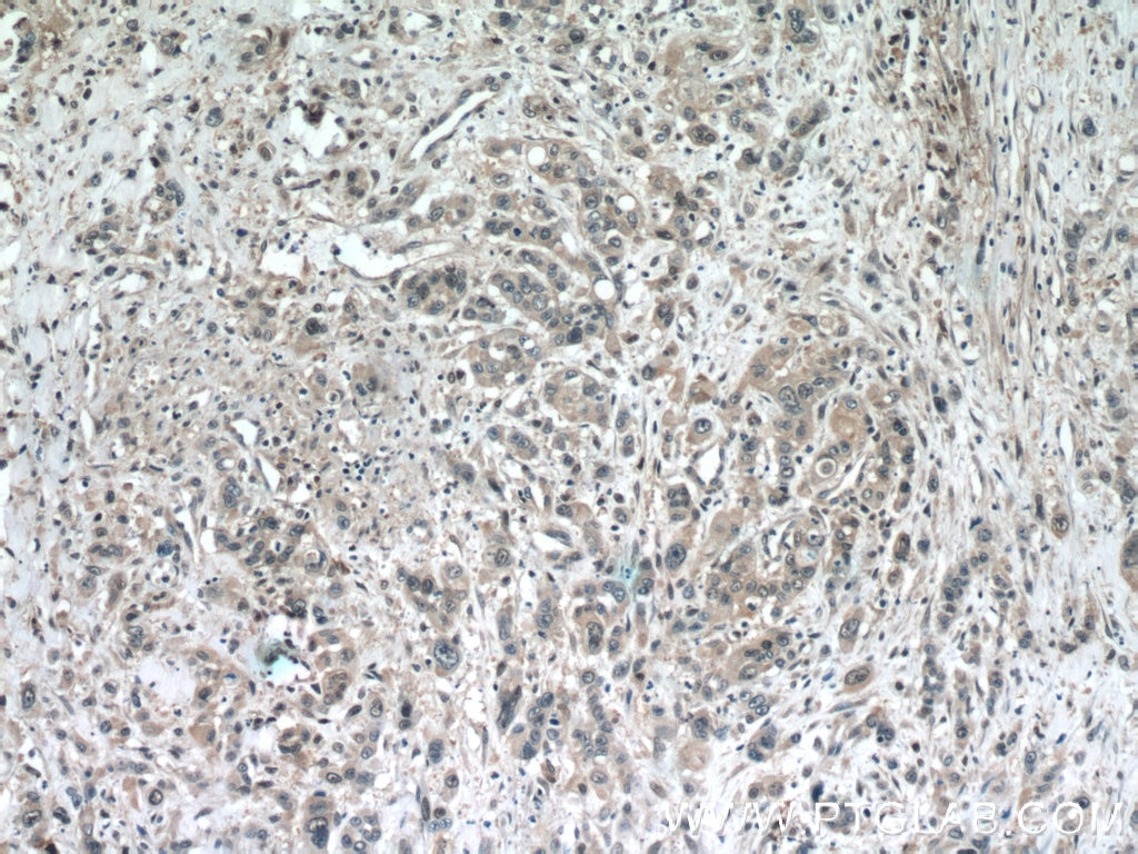 Immunohistochemistry (IHC) staining of human stomach cancer tissue using STARD8 Polyclonal antibody (13899-1-AP)