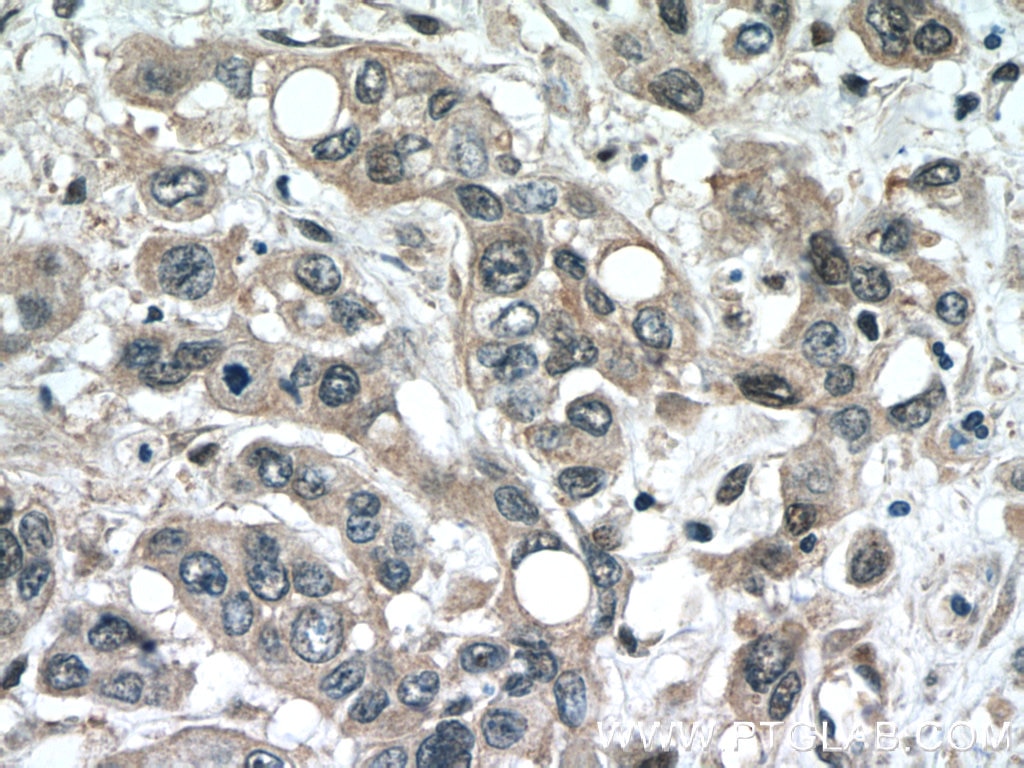 Immunohistochemistry (IHC) staining of human stomach cancer tissue using STARD8 Polyclonal antibody (13899-1-AP)