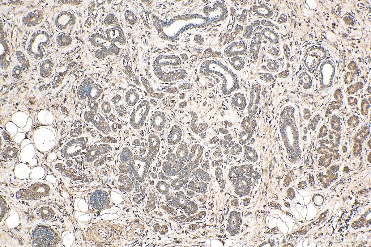 IHC staining of human breast cancer using 10144-2-AP