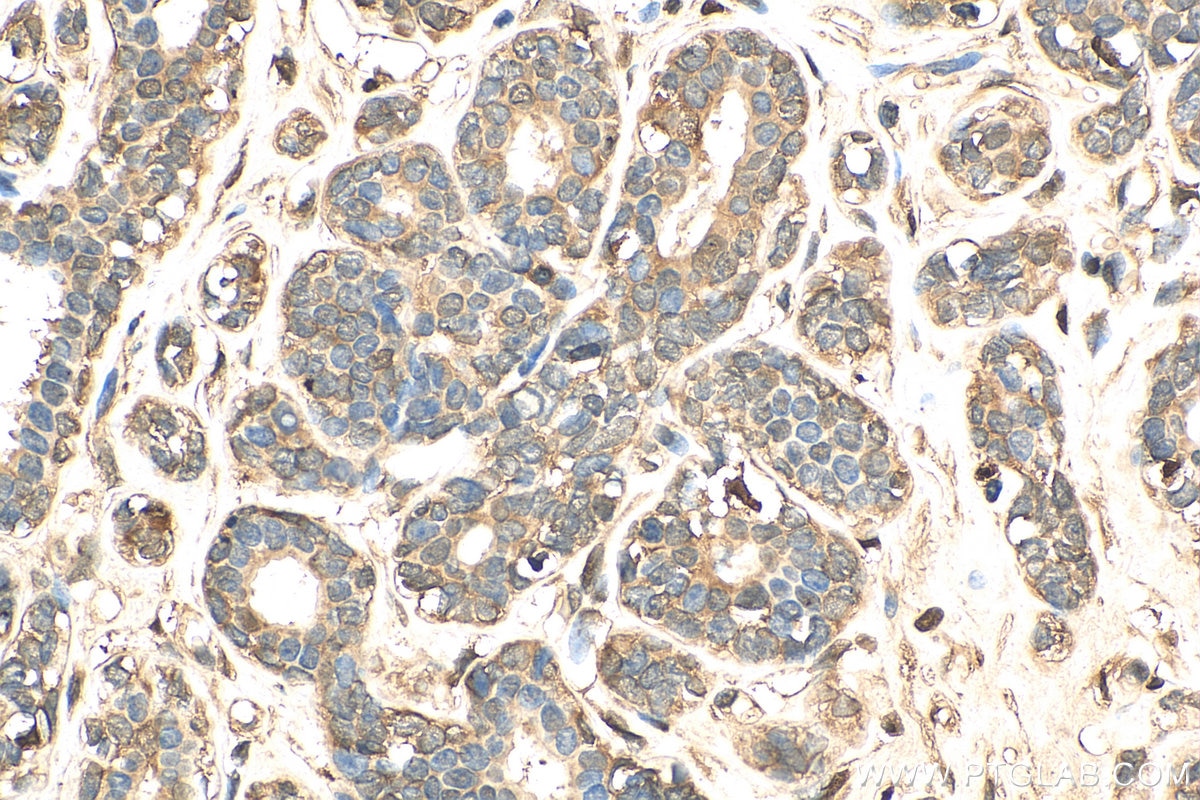 Immunohistochemistry (IHC) staining of human breast cancer tissue using STAT1 Polyclonal antibody (10144-2-AP)