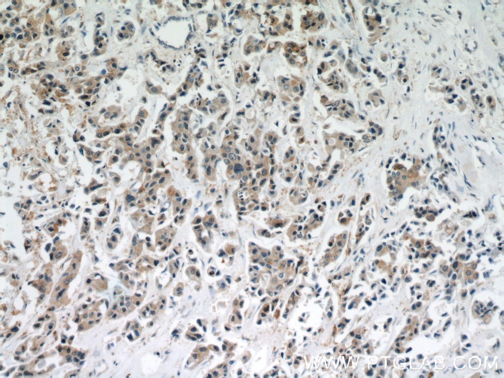 Immunohistochemistry (IHC) staining of human breast cancer tissue using STAT1 Polyclonal antibody (51117-1-AP)