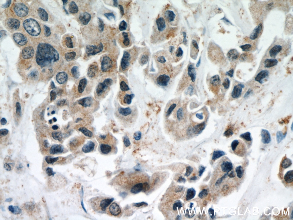 Immunohistochemistry (IHC) staining of human breast cancer tissue using STAT1 Polyclonal antibody (51117-1-AP)