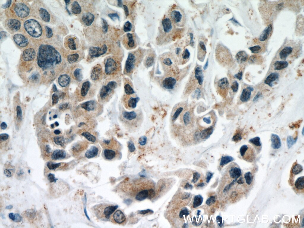 IHC staining of human breast cancer using 51117-1-AP