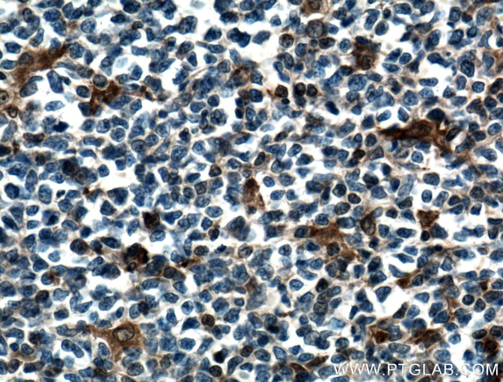 Immunohistochemistry (IHC) staining of human tonsillitis tissue using STAT1 Monoclonal antibody (66545-1-Ig)