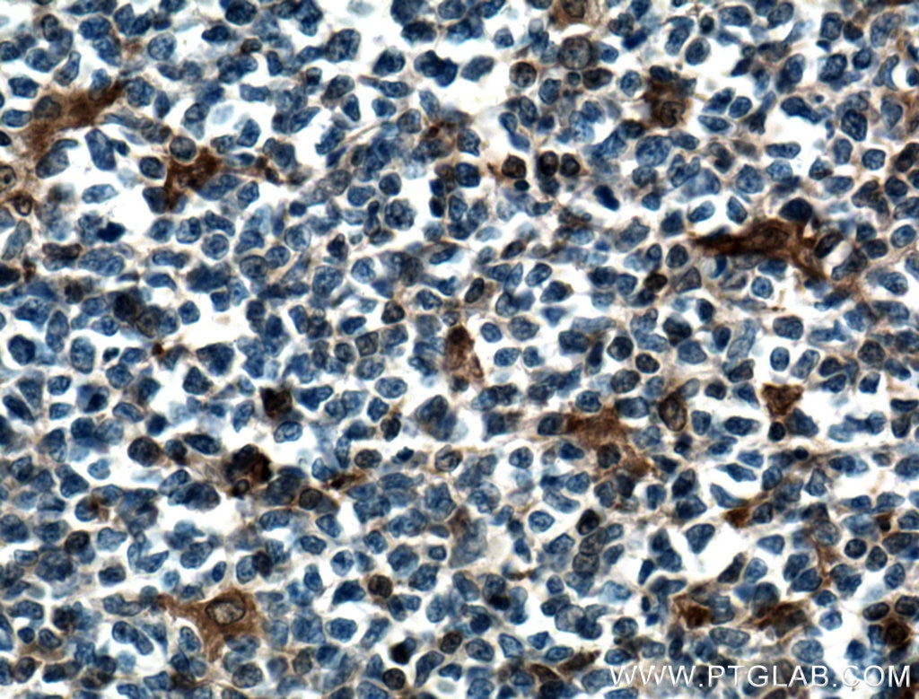 IHC staining of human tonsillitis using 66545-1-Ig