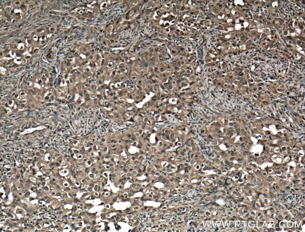 Immunohistochemistry (IHC) staining of human ovary tumor tissue using STAT1 Monoclonal antibody (66545-1-Ig)