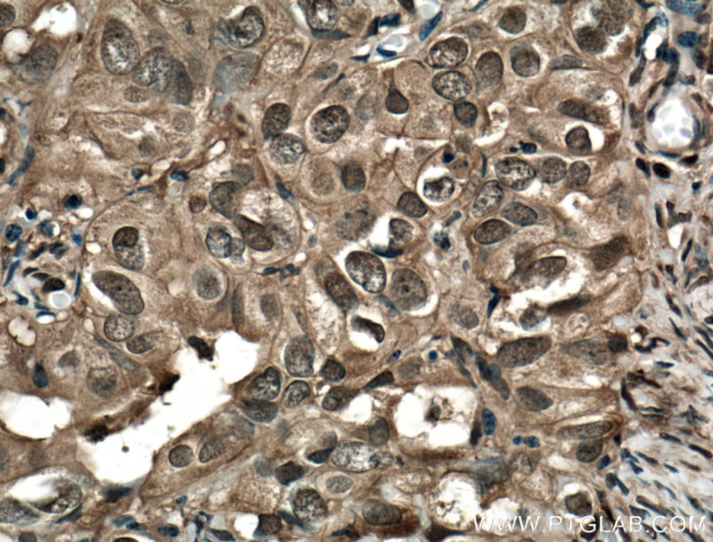 Immunohistochemistry (IHC) staining of human ovary tumor tissue using STAT1 Monoclonal antibody (66545-1-Ig)