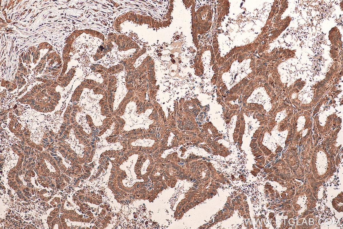 Immunohistochemistry (IHC) staining of human ovary tumor tissue using STAT1 Recombinant antibody (82016-1-RR)