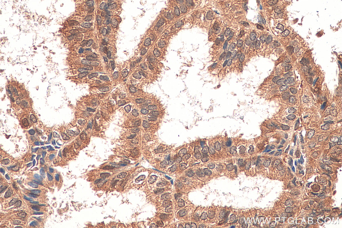 Immunohistochemistry (IHC) staining of human ovary tumor tissue using STAT1 Recombinant antibody (82016-1-RR)