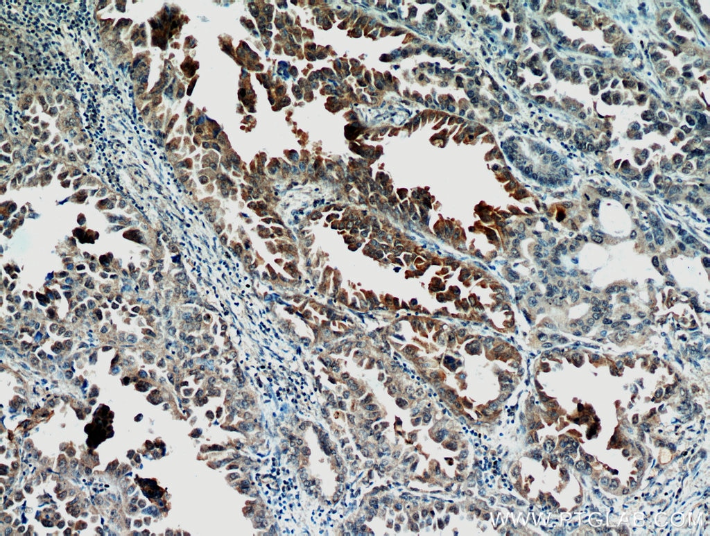 Immunohistochemistry (IHC) staining of human lung cancer tissue using STAT2 Polyclonal antibody (16674-1-AP)