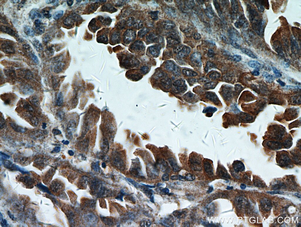 IHC staining of human lung cancer using 16674-1-AP