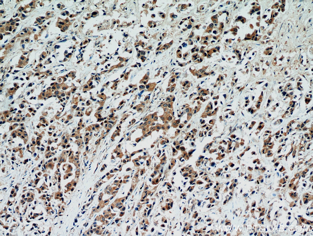 Immunohistochemistry (IHC) staining of human breast cancer tissue using STAT2 Polyclonal antibody (16674-1-AP)