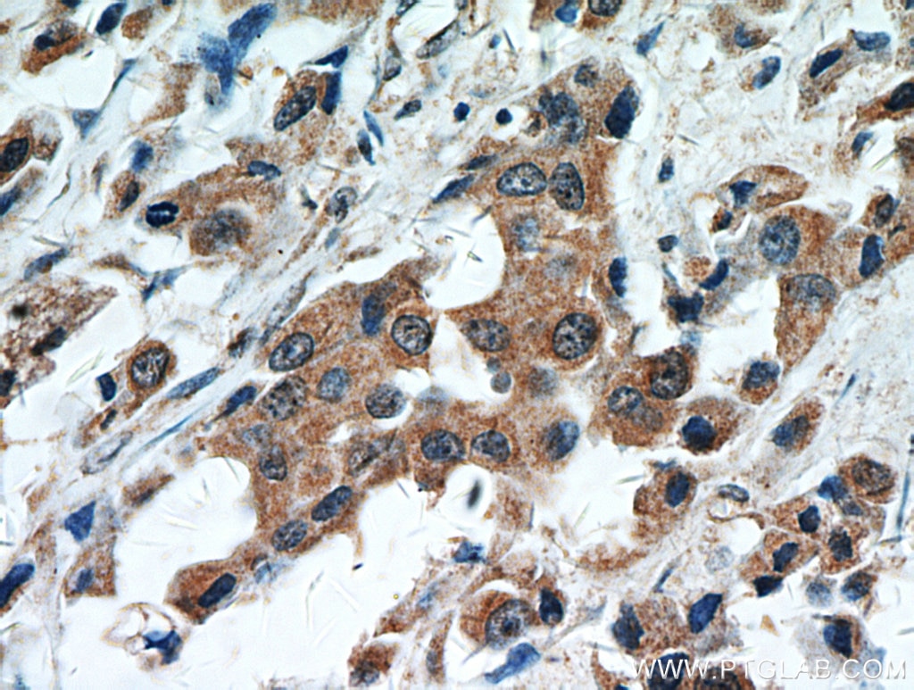 Immunohistochemistry (IHC) staining of human breast cancer tissue using STAT2 Polyclonal antibody (16674-1-AP)