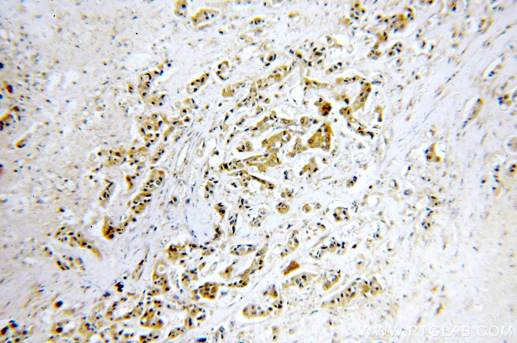 Immunohistochemistry (IHC) staining of human breast cancer tissue using STAT2 Polyclonal antibody (51075-2-AP)