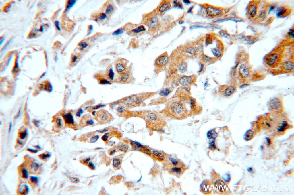 Immunohistochemistry (IHC) staining of human breast cancer tissue using STAT2 Polyclonal antibody (51075-2-AP)