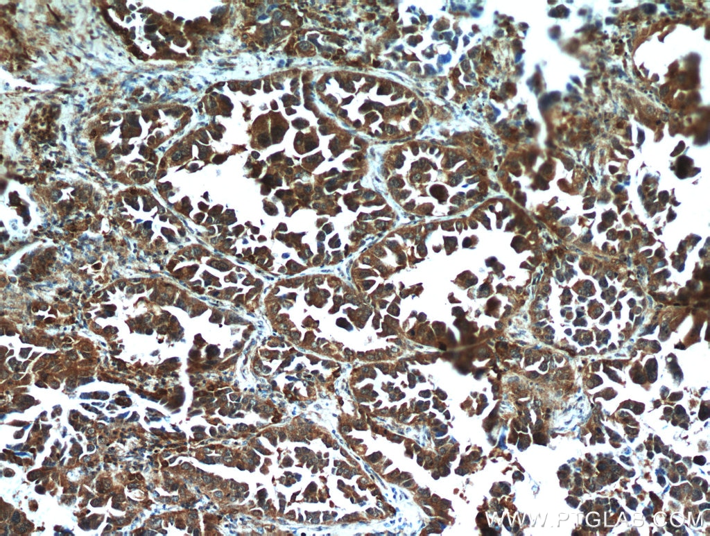Immunohistochemistry (IHC) staining of human lung cancer tissue using STAT2 Polyclonal antibody (51075-2-AP)