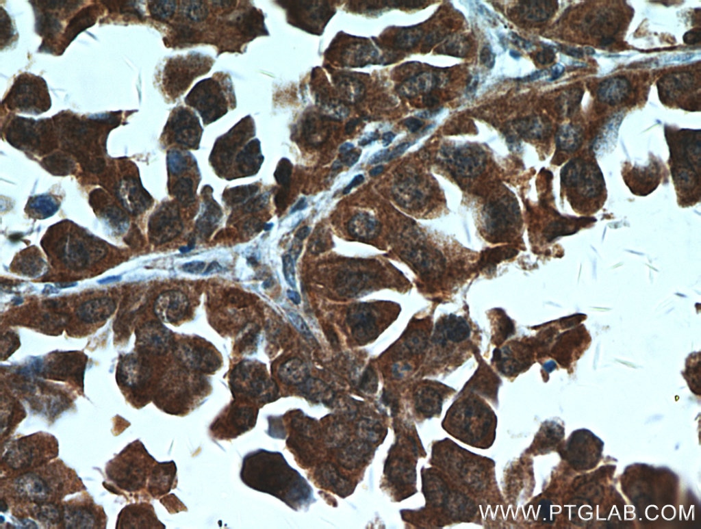 Immunohistochemistry (IHC) staining of human lung cancer tissue using STAT2 Polyclonal antibody (51075-2-AP)