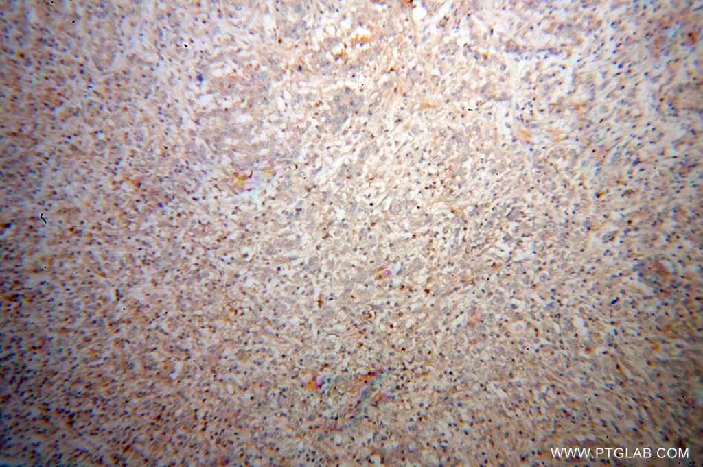 Immunohistochemistry (IHC) staining of human breast cancer tissue using STAT2 Polyclonal antibody (51075-2-AP)