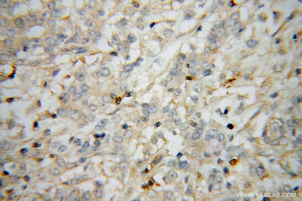 Immunohistochemistry (IHC) staining of human breast cancer tissue using STAT2 Polyclonal antibody (51075-2-AP)