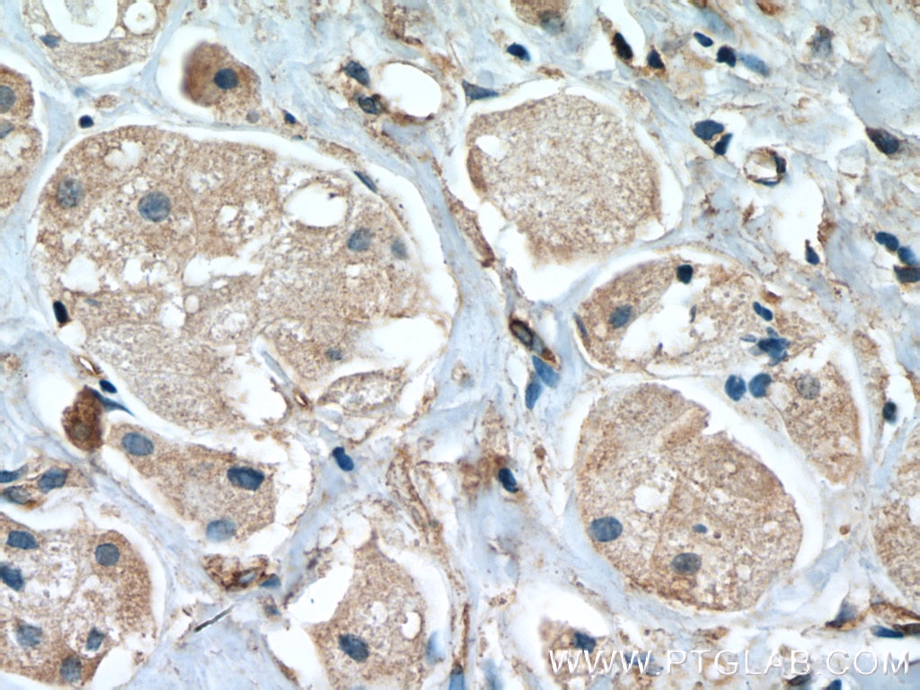 Immunohistochemistry (IHC) staining of human breast cancer tissue using STAT2 Monoclonal antibody (66485-1-Ig)