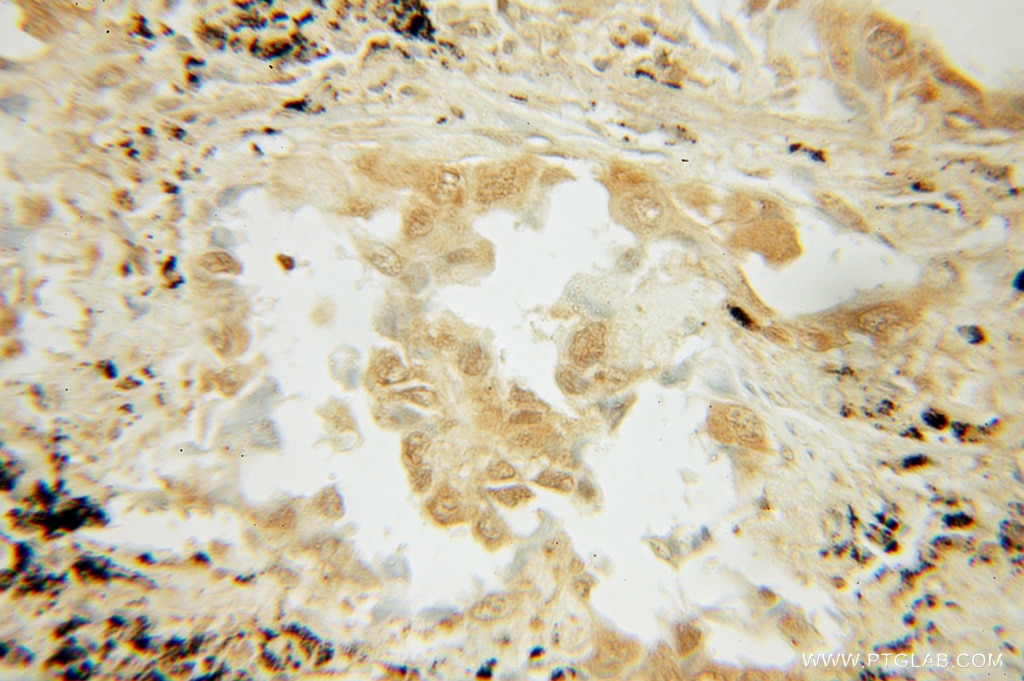 IHC staining of human lung cancer using 10025-2-AP