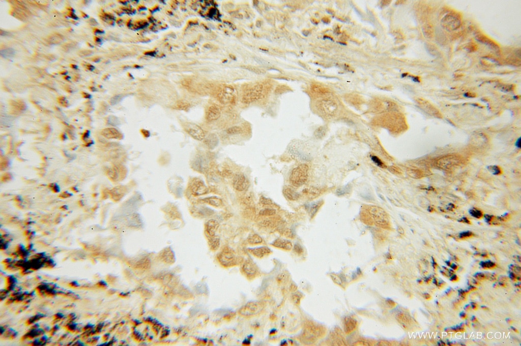 Immunohistochemistry (IHC) staining of human lung cancer tissue using STAT3 Polyclonal antibody (10025-2-AP)