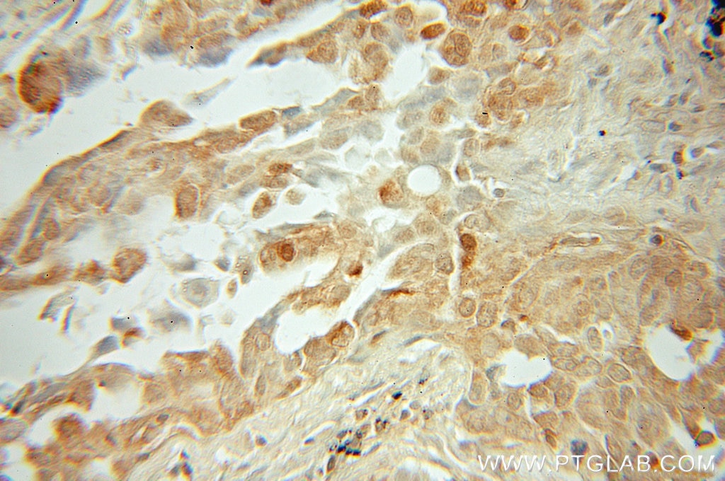 IHC staining of human lung cancer using 10025-2-AP