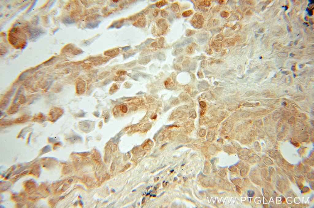 Immunohistochemistry (IHC) staining of human lung cancer tissue using STAT3 Polyclonal antibody (10025-2-AP)