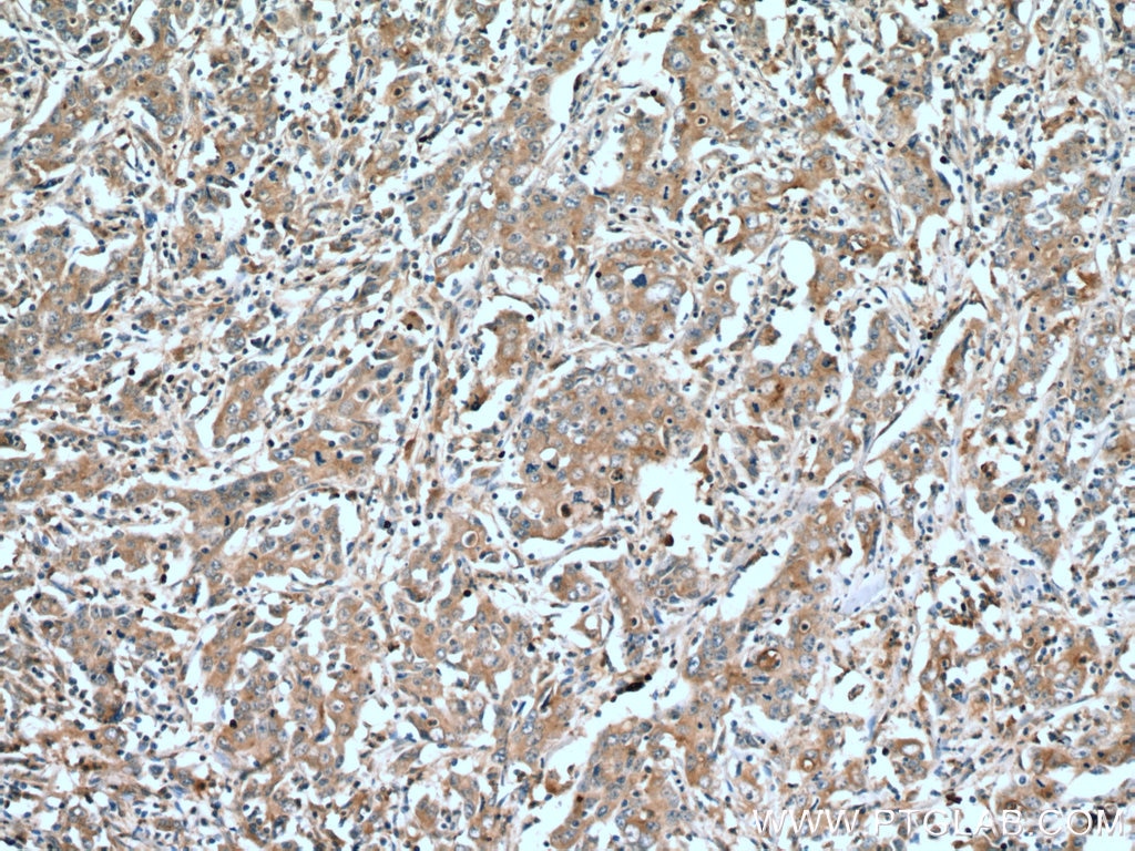 Immunohistochemistry (IHC) staining of human stomach cancer tissue using STAT3 Polyclonal antibody (10253-2-AP)