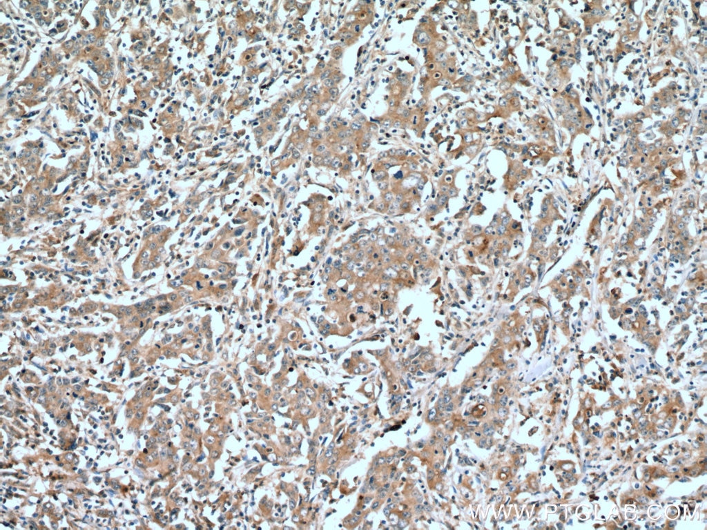 IHC staining of human stomach cancer using 10253-2-AP