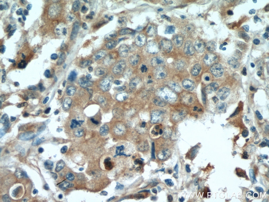 Immunohistochemistry (IHC) staining of human stomach cancer tissue using STAT3 Polyclonal antibody (10253-2-AP)