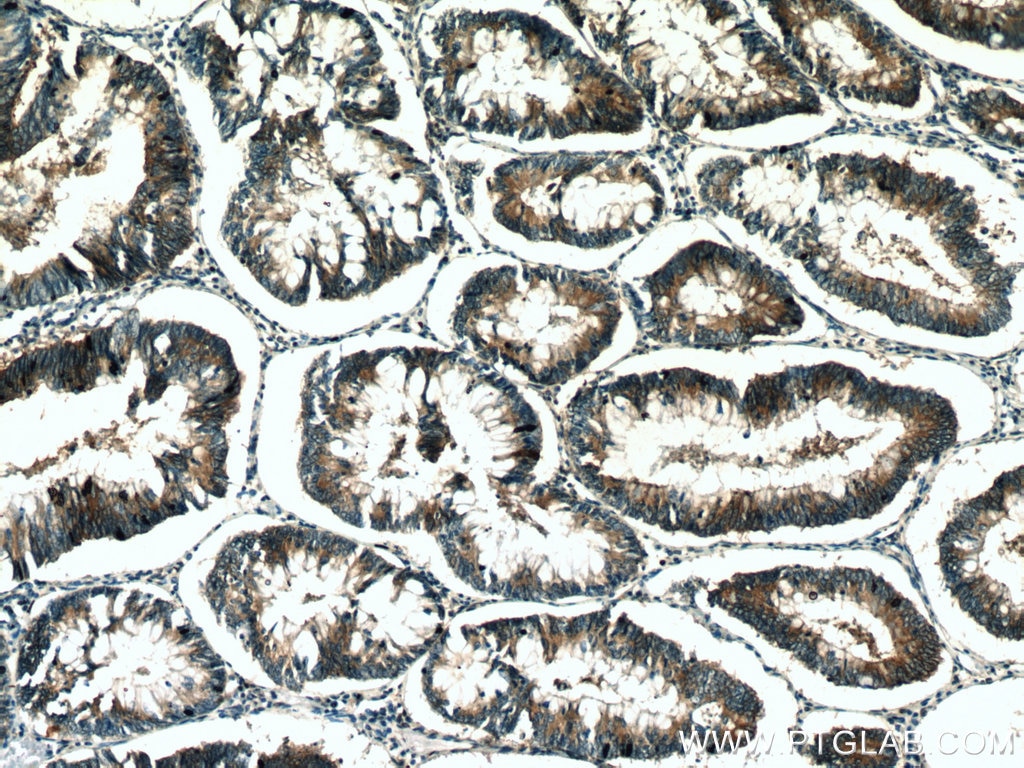 IHC staining of human colon cancer using 10253-2-AP