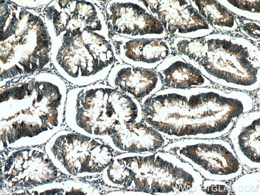 Immunohistochemistry (IHC) staining of human colon cancer tissue using STAT3 Polyclonal antibody (10253-2-AP)