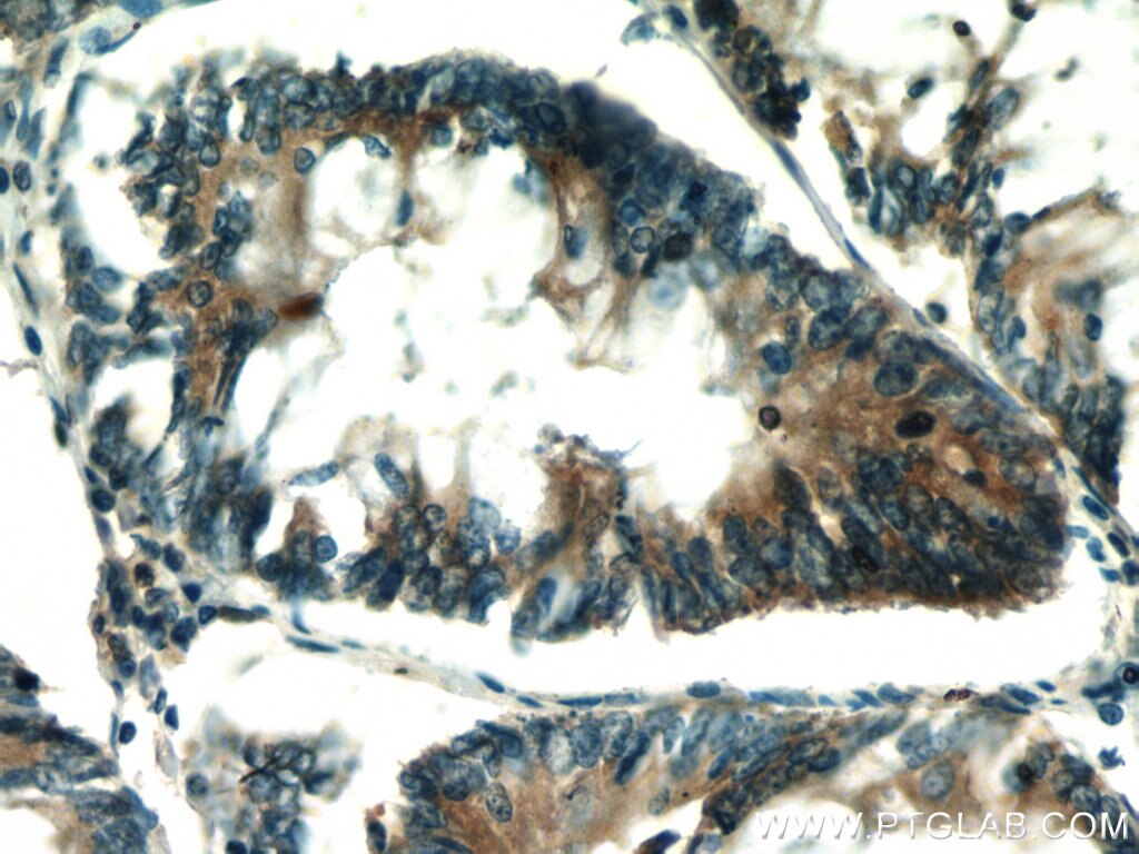 IHC staining of human colon cancer using 10253-2-AP