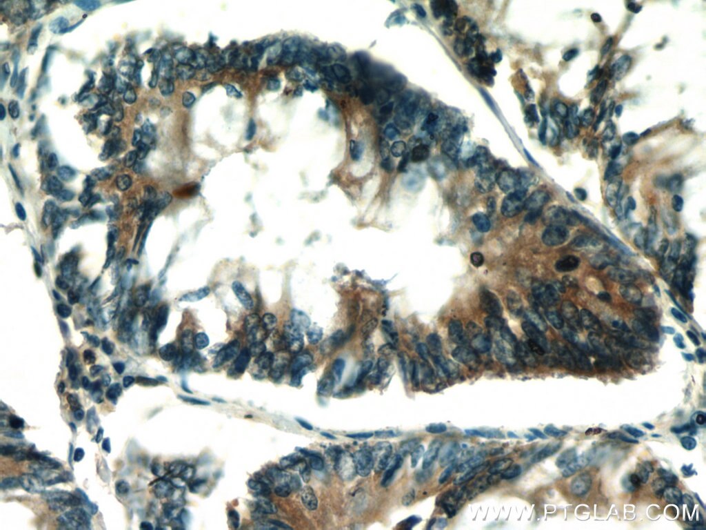 Immunohistochemistry (IHC) staining of human colon cancer tissue using STAT3 Polyclonal antibody (10253-2-AP)