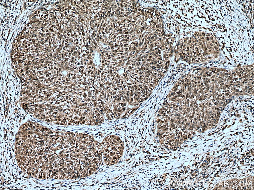 Immunohistochemistry (IHC) staining of human cervical cancer tissue using STAT3 Polyclonal antibody (10253-2-AP)