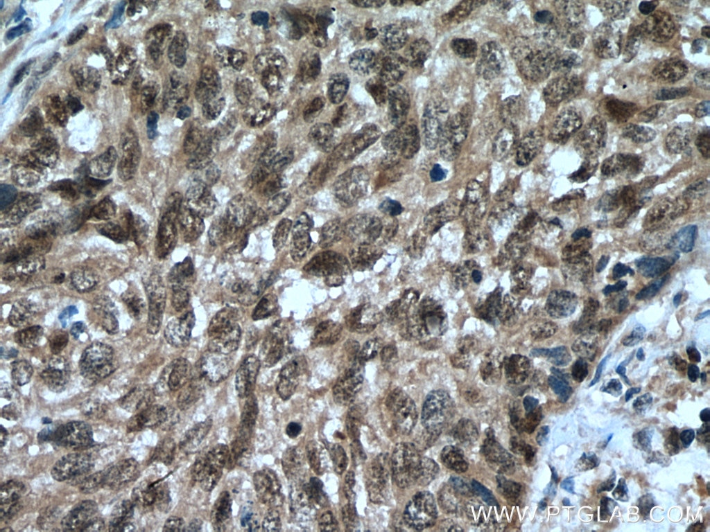 Immunohistochemistry (IHC) staining of human cervical cancer tissue using STAT3 Polyclonal antibody (10253-2-AP)