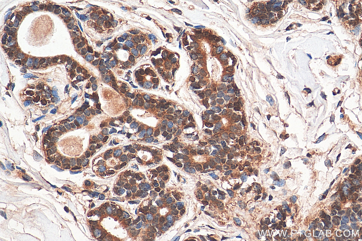 IHC staining of human breast cancer using 10253-2-AP