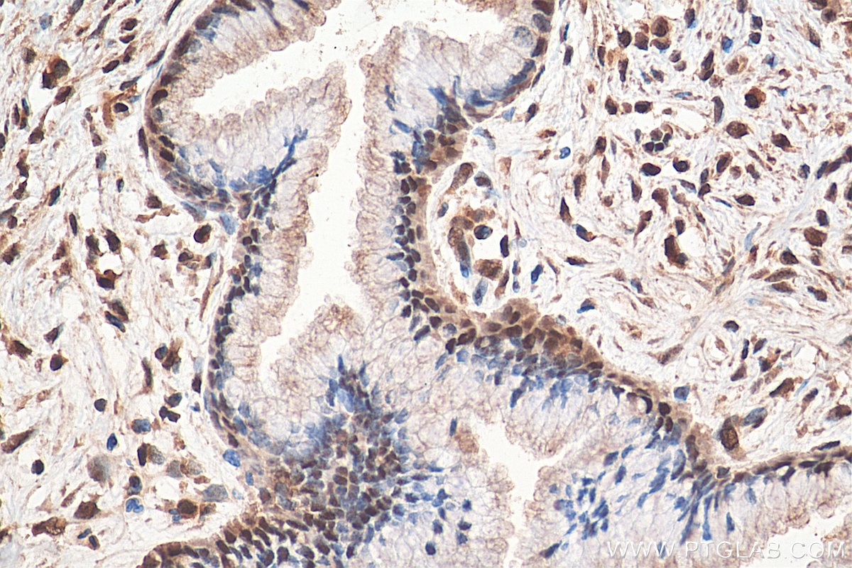 Immunohistochemistry (IHC) staining of human cervical cancer tissue using STAT3 Polyclonal antibody (10253-2-AP)