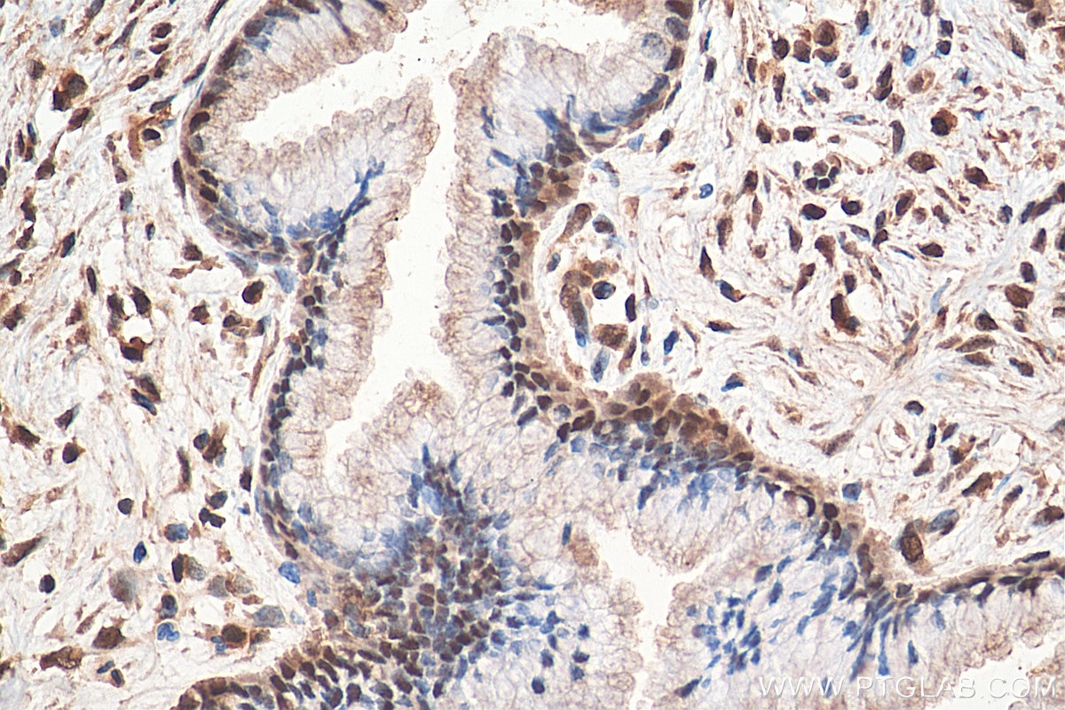 IHC staining of human cervical cancer using 10253-2-AP