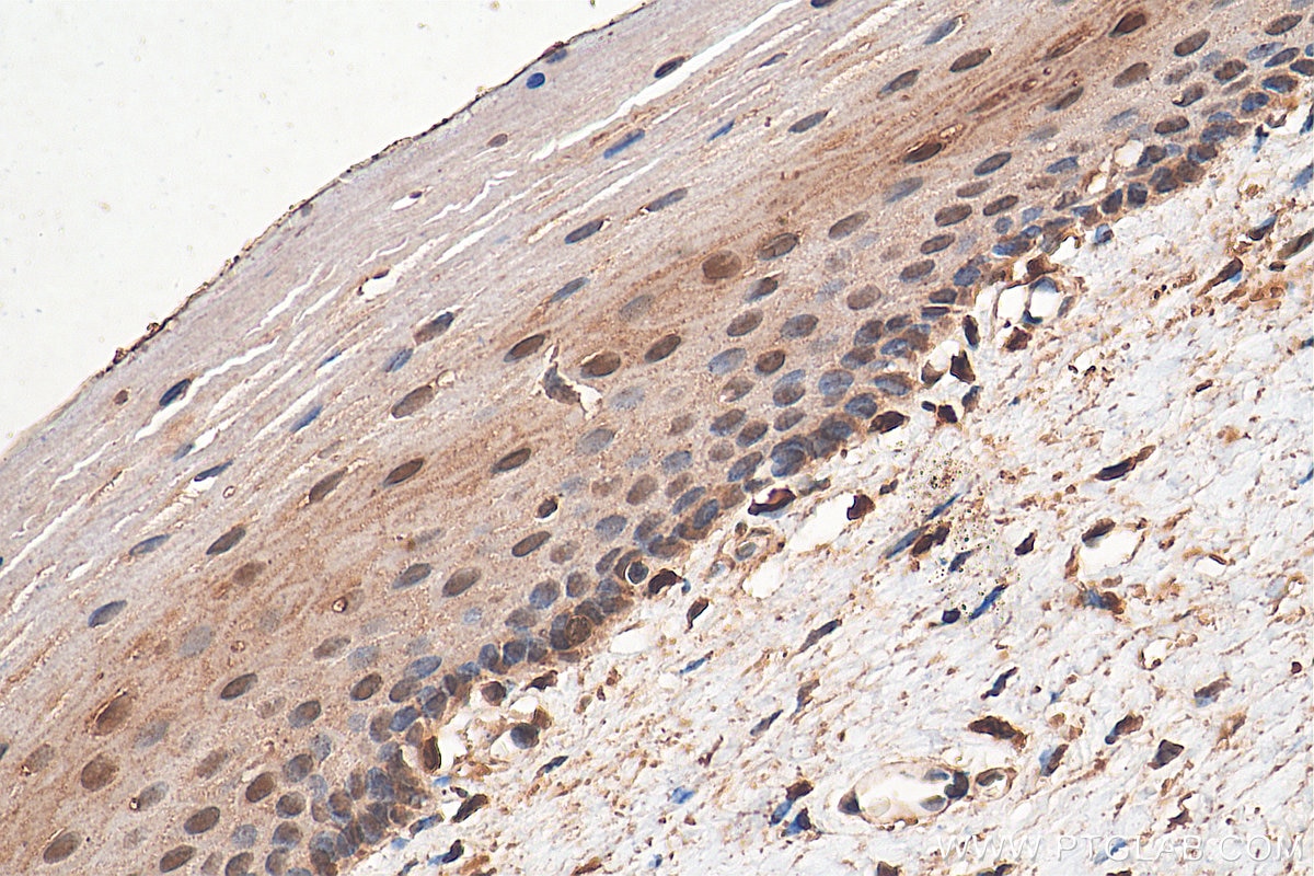 Immunohistochemistry (IHC) staining of human cervical cancer tissue using STAT3 Polyclonal antibody (10253-2-AP)