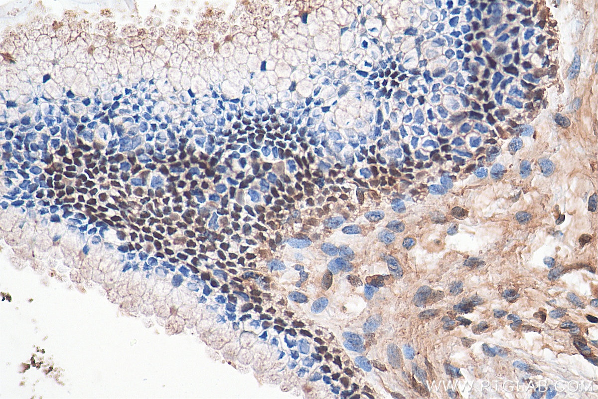 Immunohistochemistry (IHC) staining of human cervical cancer tissue using STAT3 Polyclonal antibody (10253-2-AP)