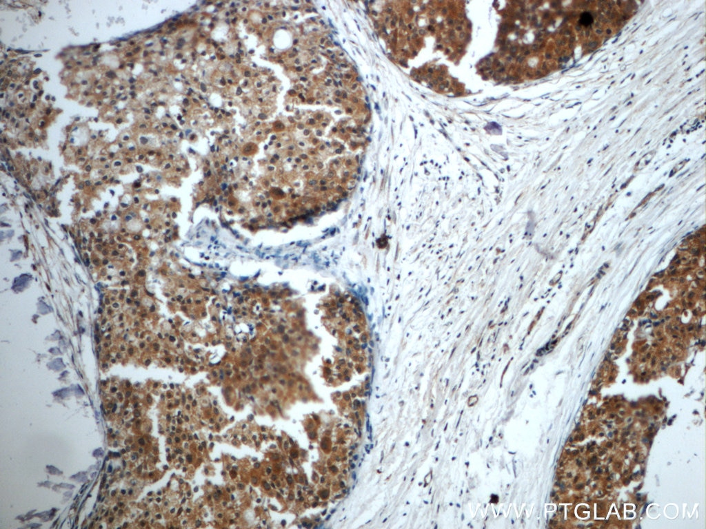 Immunohistochemistry (IHC) staining of human breast cancer tissue using STAT3 Polyclonal antibody (10253-2-AP)